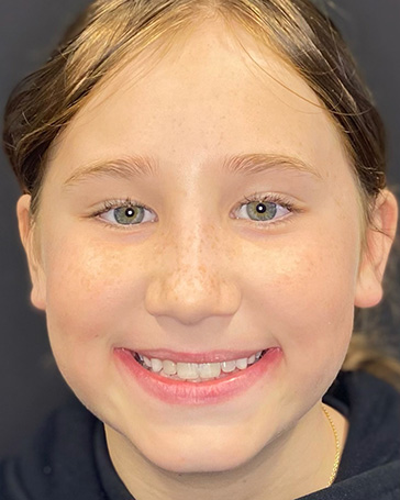 Patient of Pediatric Orthodontist in Iowa City and Coralville IA