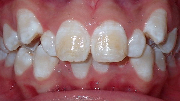 Frontal Intraoral Photo
