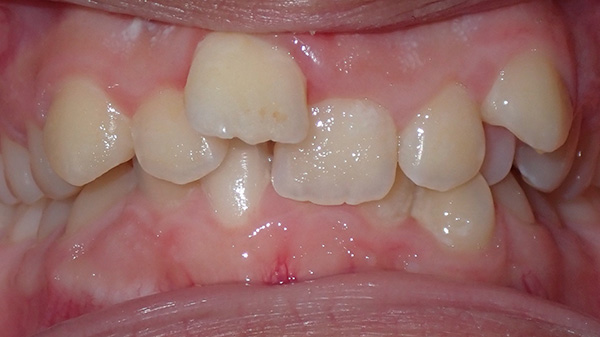 Before Orthodontics