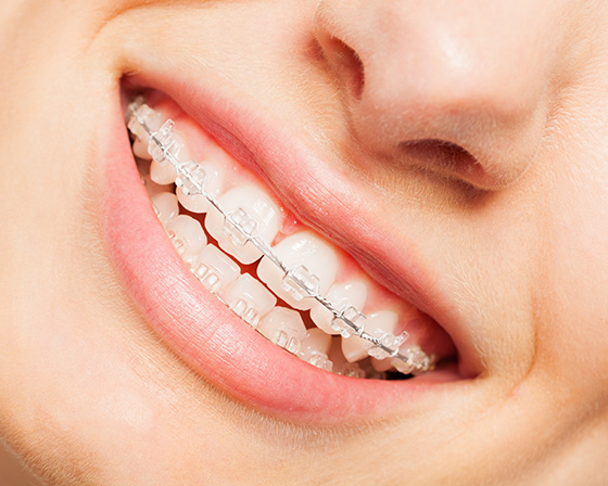 Clear Braces in Iowa City and Coralville IA