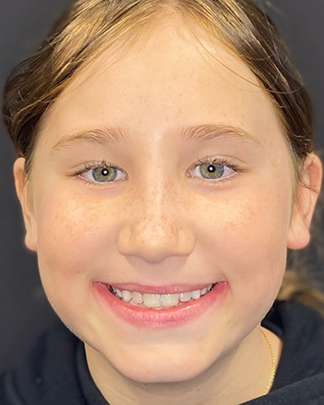 Patient of Pediatric Orthodontist in North Liberty IA