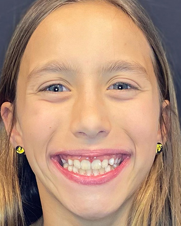 Patient of Pediatric Orthodontist in Oxford IA