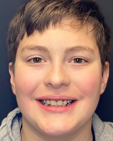 Patient of Pediatric Orthodontist in North Liberty IA